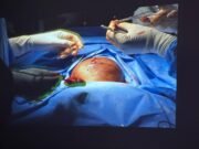 Breakthrough: Modibbo Adama Teaching hospital separate co-join twins again